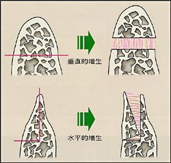 仮骨延長法による歯槽骨形成の画像