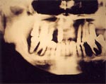 糖尿病者における重度の歯周病の画像